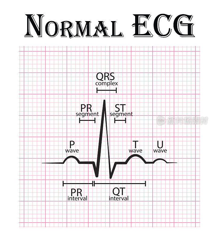 正常心电图(心电图)(P波、PR段、PR间期、QRS complex、QT间期、ST段、T波、U波)